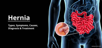 Hernia: Types, Causes, Diagnosis, Prevention And Treatment