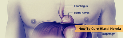 How To Cure Hiatal Hernia Naturally
