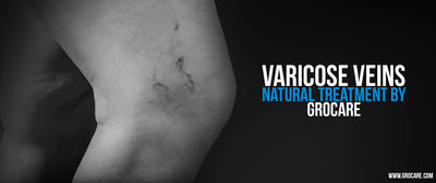How To Treat Varicose Veins Naturally - Overview, Symptoms and Diagnosis